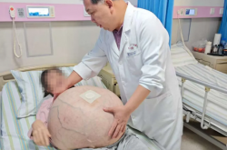河北一女子肚子长80斤罕见巨瘤：血管暴突如蛛网 4小时切下