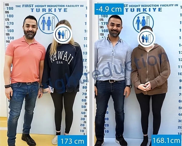 太疯狂！嫌个子太高不好找对象 女子手术切骨变矮