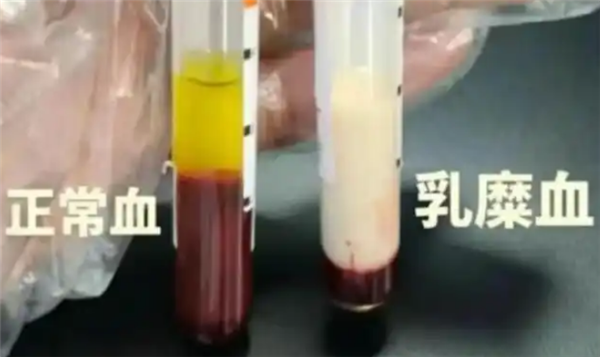 男子抽出草莓奶油血 医生紧急提醒:血脂长期偏高要注意