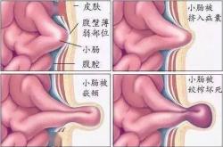 关爱老年疝气患者：春节期间的隐形风险