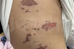 3岁男童吃火锅烫嘴后竟全身溃烂 医生：有传染性