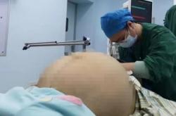 23岁女子腹胀如鼓取出42斤肿瘤：该肿瘤为良恶交界性质