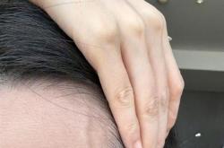 张靓颖自曝体检查出营养不良：额头血管莫名突起 伸懒腰手掌就流血