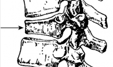 为什么女子滑了一下 轻轻坐地 竟然就腰椎骨折了