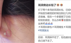 为什么没有人告诉我 打耳洞后会长这种肉疙瘩啊