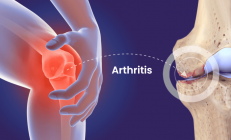 70万人研究表明，常吃这类食物可能会得关节炎