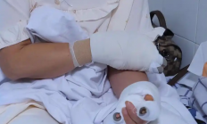 贵阳阿姨河道捡到漂亮石头 竟自燃导致自己四肢烧伤