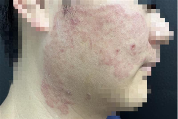 宁波小伙拿擦脚巾擦脸 结果脚气上脸!专家:有人闻臭袜肺部感染