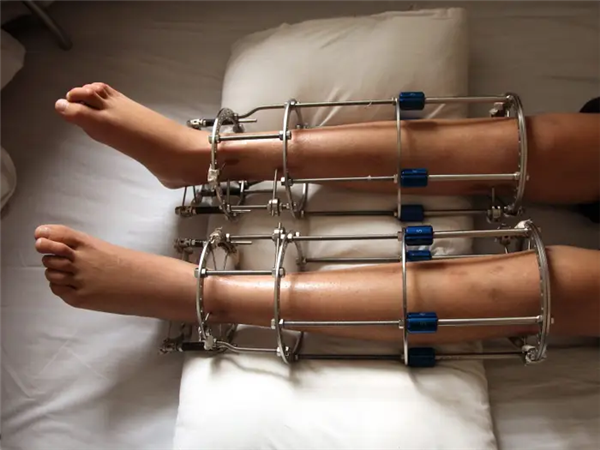 太疯狂！嫌个子太高不好找对象 女子手术切骨变矮