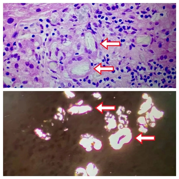 这种常见蔬菜吃多了 居然会引发严重急性肾损伤！