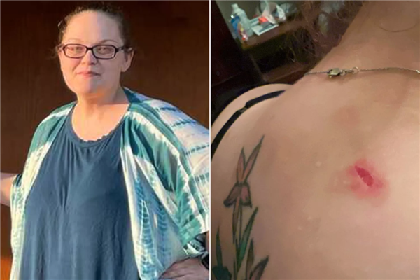 子弹卡在脂肪层 美国女子遇歹徒连中7枪奇迹生还!